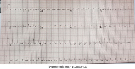 Atrial Tachycardia With First Degree Av Block. CS Ostium AT.