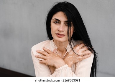 Attractive Woman Shows Hands With Spots Of Vitiligo Pigmentation. Lifestyle With Skin Seasonal Diseases