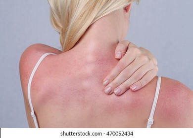 Attractive Woman With Sunburn. Sun Skin Care