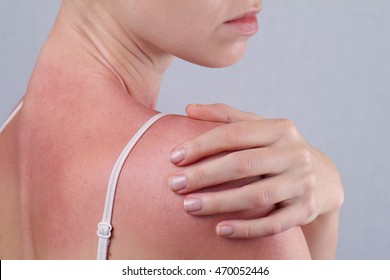 Attractive Woman With Sunburn. Sun Skin Care