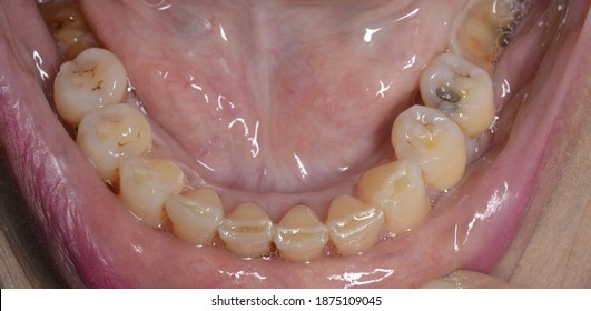 Attrition Of Anterior Lower Mandible In Old Patient