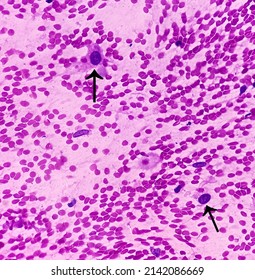 Atypical Cells, Smear Show Mostly Regular Oval To Spindle Shaped Cells, Mild Pleomorphism, Background Shows Blood.