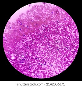 Atypical Cells, Smear Show Mostly Regular Oval To Spindle Shaped Cells, Mild Pleomorphism, Background Shows Blood.