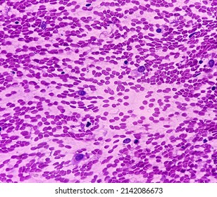 Atypical Cells, Smear Show Mostly Regular Oval To Spindle Shaped Cells, Mild Pleomorphism, Background Shows Blood.