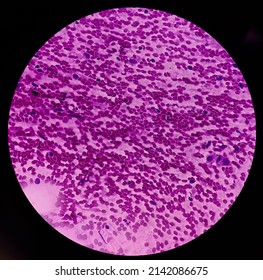 Atypical Cells, Smear Show Mostly Regular Oval To Spindle Shaped Cells, Mild Pleomorphism, Background Shows Blood.