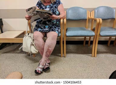 August 2019, Swansea, UK. Woman With A Bad Skin Condition On Her Legs In The Waiting Room At A NHS Hospital.
