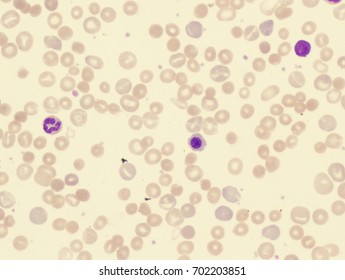 Autoimmune Hemolytic Anemia (AIHA)