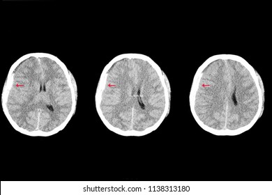 A Axial Brain CT Scan Of A Patient With Traumatic Injury Showing Right Subdural Hemorrhage And Edema With Shifting Of The Brain To The Left. Intra Cerebral Bleeding And Blood Clots From Car Accident. 