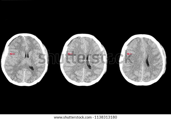 A axial brain CT scan of a patient with\
traumatic injury showing right subdural hemorrhage and edema with\
shifting of the brain to the left. Intra cerebral bleeding and\
blood clots from car accident.\
