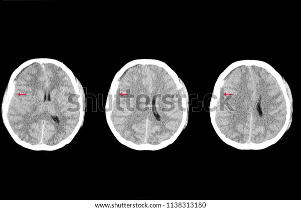 右硬膜下出血と脳の左方への移動による浮腫を示す外傷性外傷を持つ患者の軸方向脳ctスキャン 車の事故で脳内出血や血栓ができた の写真素材 今すぐ編集