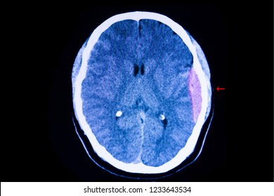 An Axial Cross Sectional CT Scan Of The Brain Of A Traffic Accident Patient Showing Large Epidural Hemorrhage And Blood Clot In His Left Cerebral Hemisphere With Some Degree Of Brain Edema.