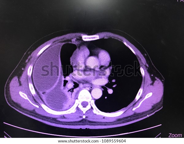 Axial Ct Chest Iv Contrast Show Stock Photo Edit Now 1089559604