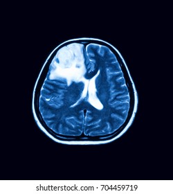 Axial MRI Of The Brain, Intracerebral Hemorrhage HTC