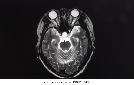 an axial projection of magnetic resonance image or MRI showing brain and sulcus with eyeballs and optic nerves.
