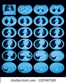 Axial View Of The Chest Without Intravenous Contrast Administration, Case Of Superior Venacava Obstruction (SVC Obstruction), A 38 Year Old Female 