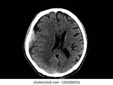 An Axial View Computer Tomography Or CT Scan Of Brain And Skull Showing Epidural Hematoma Or Hemorrhage On Right Side Of The Brain. The Patient Has Head Injury From Motorcycle Accident.