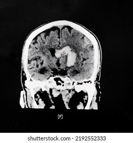 An Axial View Computer Tomography Or CT Scan Of Brain And Skull Showing Large Intracerebral Hematoma Or Hemorrhage On Both Side Of The Brain. The Patient Has Severe Hypertension And Diabetes.