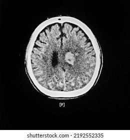 An Axial View Computer Tomography Or CT Scan Of Brain And Skull Showing Large Intracerebral Hematoma Or Hemorrhage On Both Side Of The Brain. The Patient Has Severe Hypertension And Diabetes.