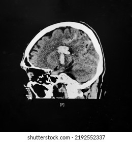 An Axial View Computer Tomography Or CT Scan Of Brain And Skull Showing Large Intracerebral Hematoma Or Hemorrhage On Both Side Of The Brain. The Patient Has Severe Hypertension And Diabetes.