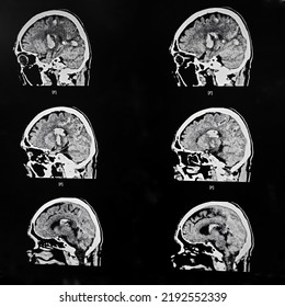 An Axial View Computer Tomography Or CT Scan Of Brain And Skull Showing Large Intracerebral Hematoma Or Hemorrhage On Both Side Of The Brain. The Patient Has Severe Hypertension And Diabetes.