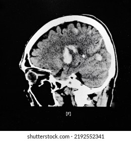 An Axial View Computer Tomography Or CT Scan Of Brain And Skull Showing Large Intracerebral Hematoma Or Hemorrhage On Both Side Of The Brain. The Patient Has Severe Hypertension And Diabetes.