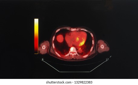 An Axial View Of Positron Emission Tomography Or PET Scan Showing Normal Heart Anatomy And Function