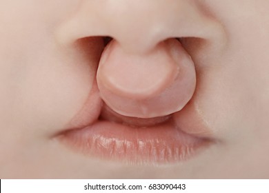 唇と口蓋の裂け目を持つ赤ちゃん 唇の接写 手術前に出生不良で生まれた赤ちゃん の写真素材 今すぐ編集