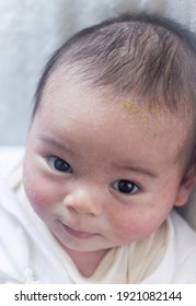 Baby Boy With Eczema And Cradle Cap