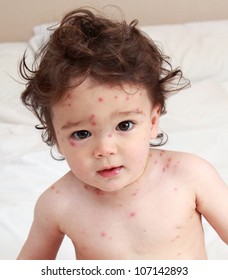 Baby With Chicken Pox Rash