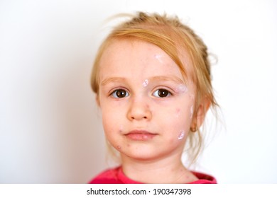 Baby Chicken Pox Rash Stock Photo 190347398 | Shutterstock