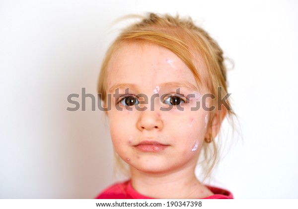 Baby Chicken Pox Rash Stock Photo 190347398 | Shutterstock