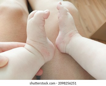 Baby Feet In Plaster Cast Medical Intervention Cure