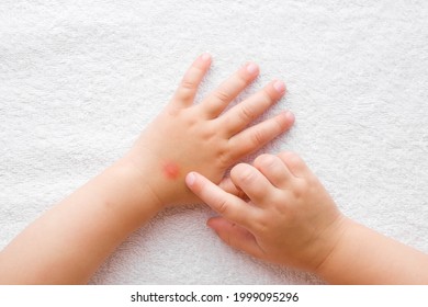 Baby Girl Finger Pointing To Itchy Hand Skin After Mosquito Bites On White Towel Background. Point Of View Shot. Closeup.