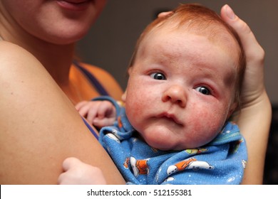 The Baby Has Eczema On His Face