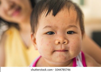 the baby has rashes on her face because she get Infectious mononucleosis that is usually caused by Epstein–Barr virus, also known as human herpesvirus or kissing disease.