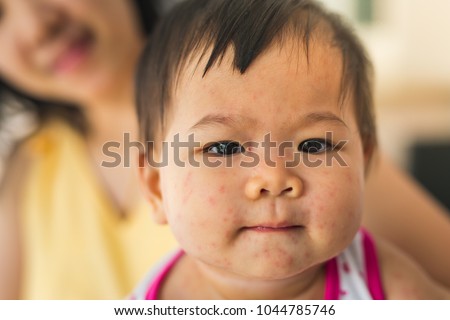 the baby has rashes on her face because she get Infectious mononucleosis that is usually caused by Epstein–Barr virus, also known as human herpesvirus or kissing disease. Stock photo © 