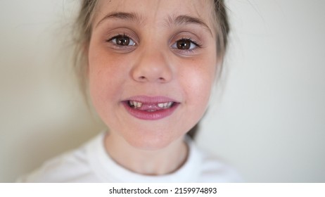 Baby No Teeth. Child Smiling No Milk A Teeth Fell Out. Medicine Dentistry Happy End Family. Girl Kid Close-up Smile Without Teeth Lifestyle. Daughter Without Front Teeth Portrait