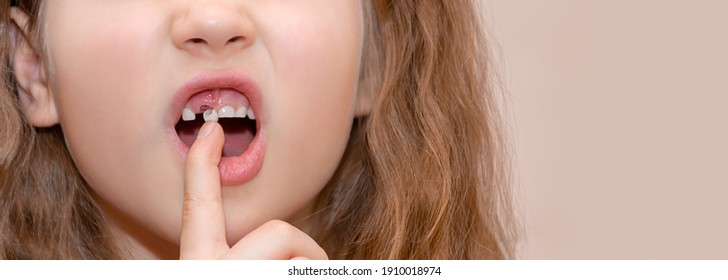 A Baby With An Open Mouth Drops Out A Loose (swinging) Baby Tooth. New Molar In The Socket. She Wiggles Her Tooth With Her Finger. Copy Space.