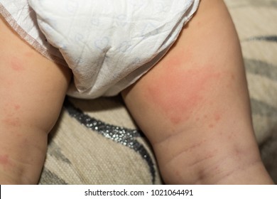 Baby With A Rash