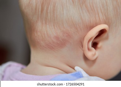 Baby Rash On The Neck,back On The Neck Of The Baby Rash Of Pimples From Sweat