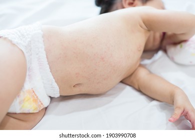Hautausschlag für Säuglinge, prickelnde Hitze für das Baby