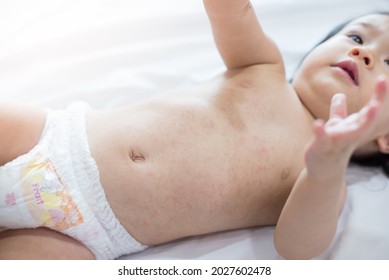 Baby Rash Skin, Prickly Heat On Baby (selective Focus)	