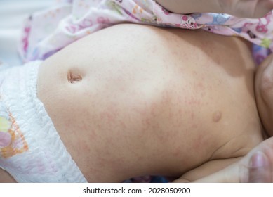 Hautausschlag, pricklige Hitze beim Baby (selektiver Fokus)	
