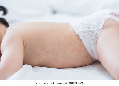 Hautausschlag, pricklige Hitze beim Baby (selektiver Fokus)	