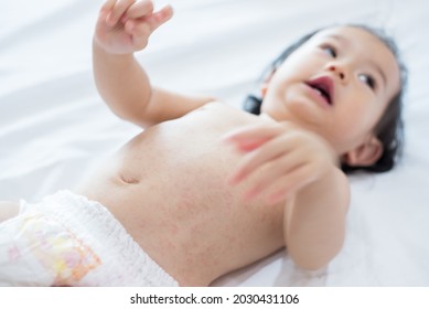 Baby Rash Skin, Prickly Heat On Baby (selective Focus)	