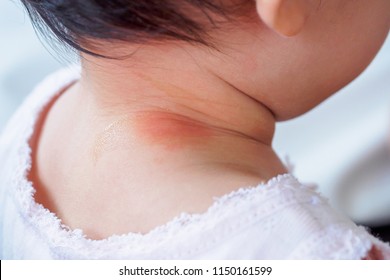 Baby Skin Rash And Allergy With Red Spot Cause By Mosquito Bite At Neck