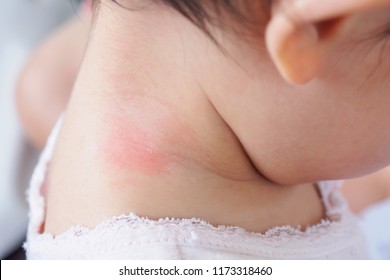 Baby Skin Rash And Allergy With Red Spot Cause By Mosquito Bite At Neck