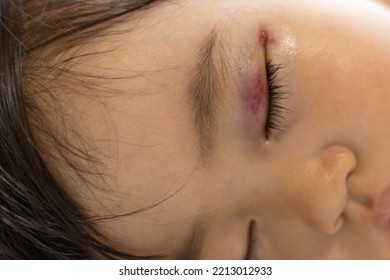 Baby With Swollen Eyelids And Internal Bleeding (2 Years And 3 Months, Girl, Japanese)