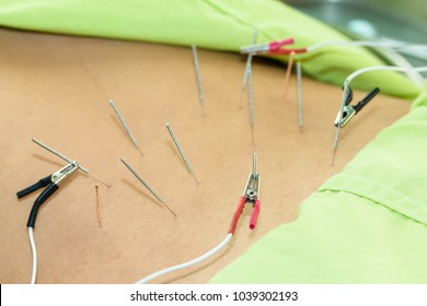 Back Acupuncture with Electrical stimulator