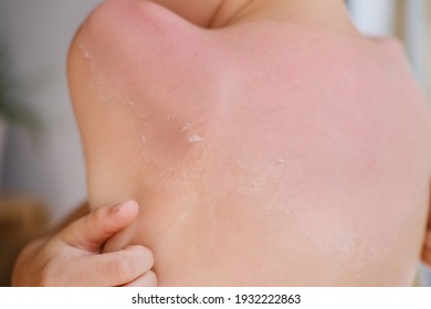 Back Of A Child With Sunburns And Peeling Dead Skin Of A 6-7 Year Old Boy With Sunscreen, Body Hygiene Concept, Sunburn